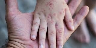 Nuevos casos de sarampión en Paraguay