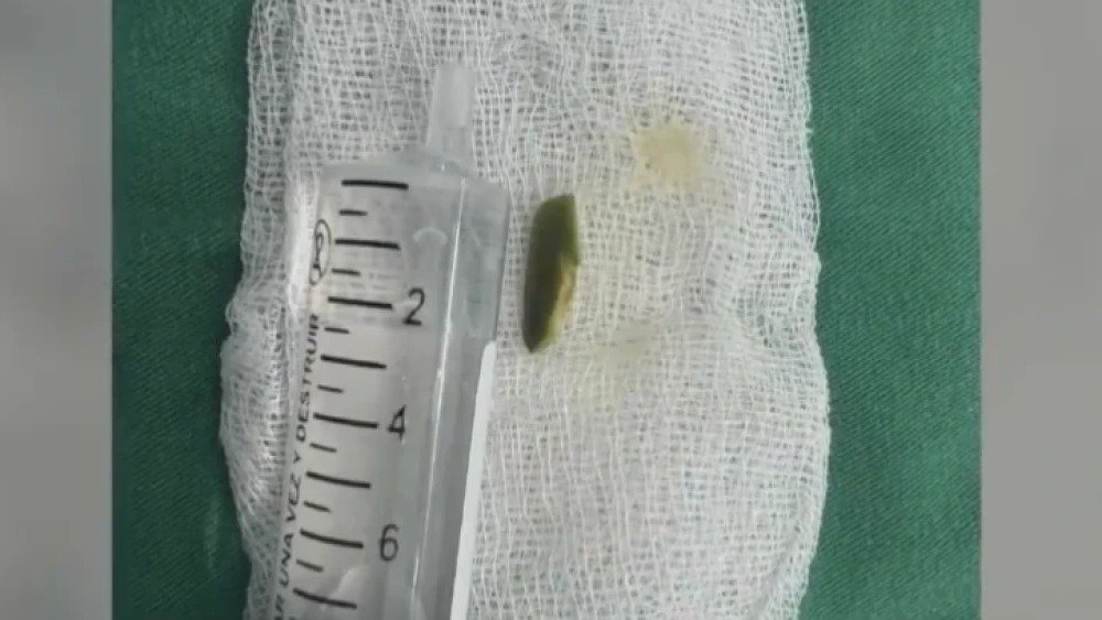 Bebé sometido a cirugía tras ingerir semilla